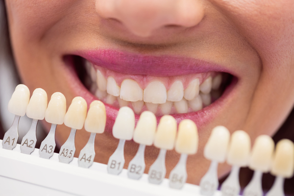 Carillas dentales estéticas