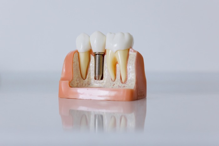 Implantes dentales en Vitoria